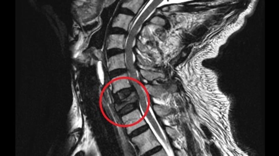 男子肩頸痠痛經揪出是頸椎第七節轉移性腫瘤害的。(圖/活力得中山脊椎外科醫院提供)
