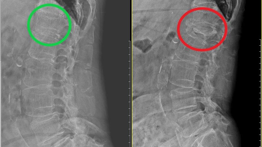 婦人因腰痛就醫，原本未有骨折的腰椎第一節（左），僅隔約兩周後，竟出現壓迫性骨折（右），且經骨密檢查確定為骨鬆。(圖/活力得中山脊椎外科醫院提供)